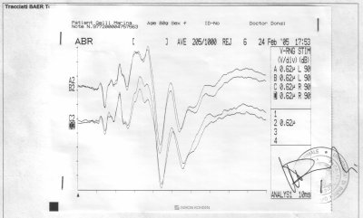 audiometria